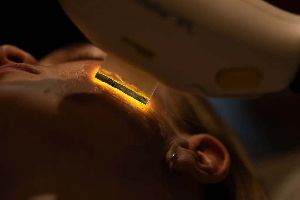 IPL hoito on valoimpulssihoito. Rosacea, verisuonet, akne, hyperpigmentaation hoitoon.